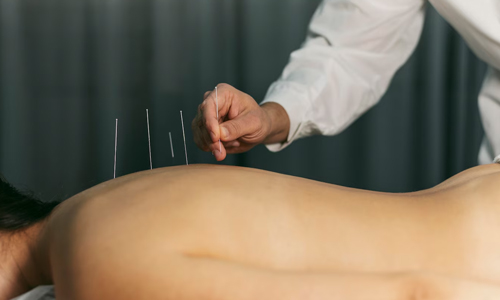Acupuncture