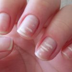 What causes white spots on nails?