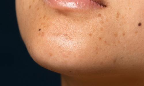 Keeps Pores Open