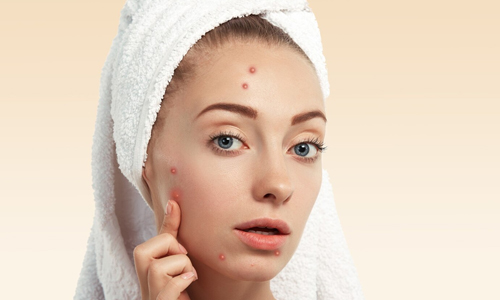 Relieves the Skin from Acne