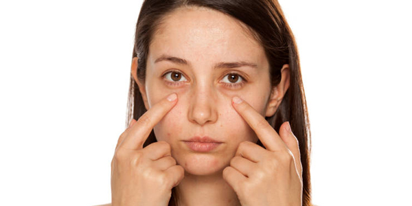 Dark Circles under Eyes