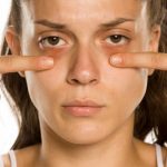 Dark Circles under Eyes