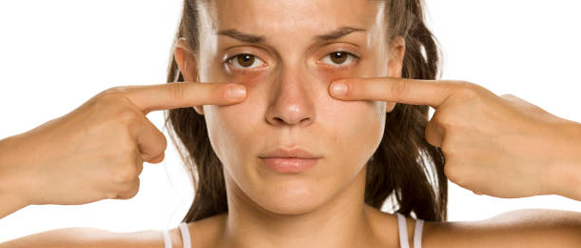 Dark Circles under Eyes