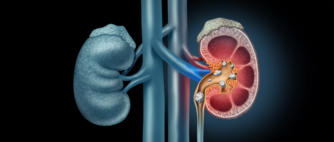 Kidney Stones : Causes, Symptoms, Home Remedies, Diet Plan