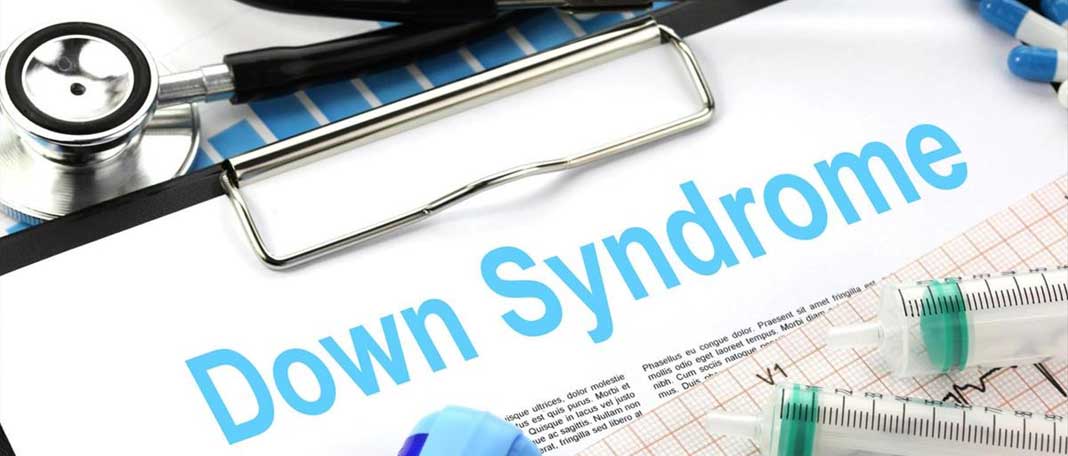Down Syndrome Patients Are More Vulnerable to COVID 19!