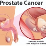 Theranostics as a Treatment for Prostate Cancer