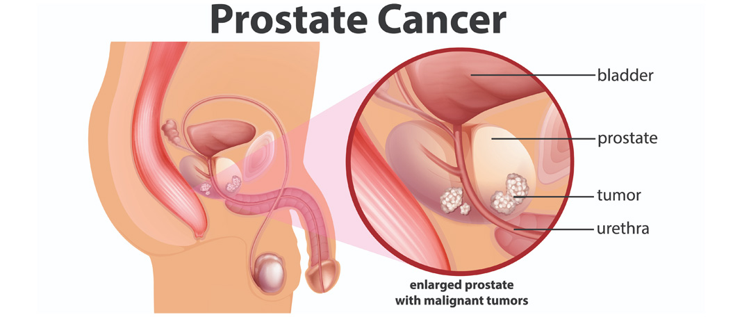 Theranostics as a Treatment for Prostate Cancer