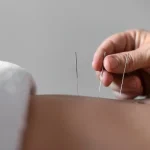 Benefits of Acupuncture: What to Know Before You Try It