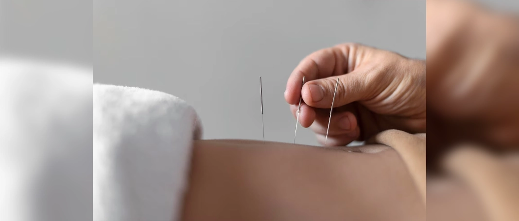 Benefits of Acupuncture: What to Know Before You Try It
