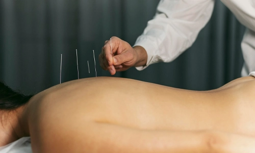 Practitioner placing thin acupuncture needles during treatment