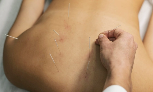 Acupuncture process close up