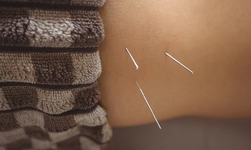close up image of a patient getting dry needling acupuncture treatment