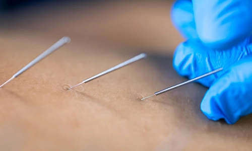 Close up of a needle and hands of physiotherapist doing a dry needling