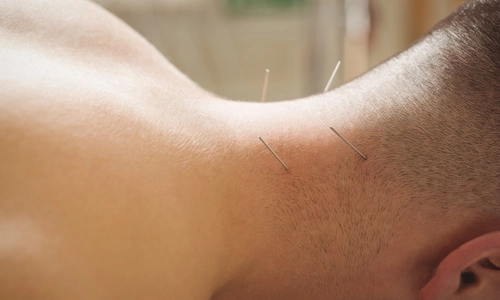 Patient getting dry needling on back side of neck