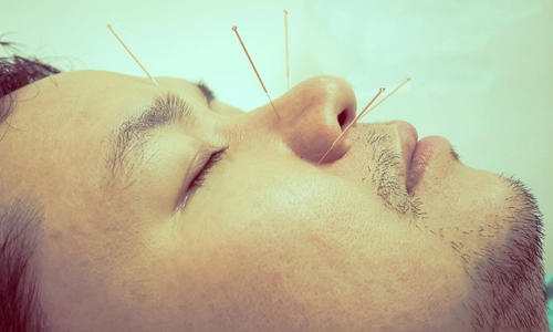 Vintage style photo of asian man is receiving acupuncture treatment