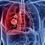 Mortality Due to TB Is Higher Than COVID Deaths?