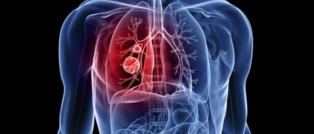 Mortality Due to TB Is Higher Than COVID Deaths?
