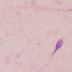 Biomarkers in Human Sperm Are Linked to Their Offspring’s Autism