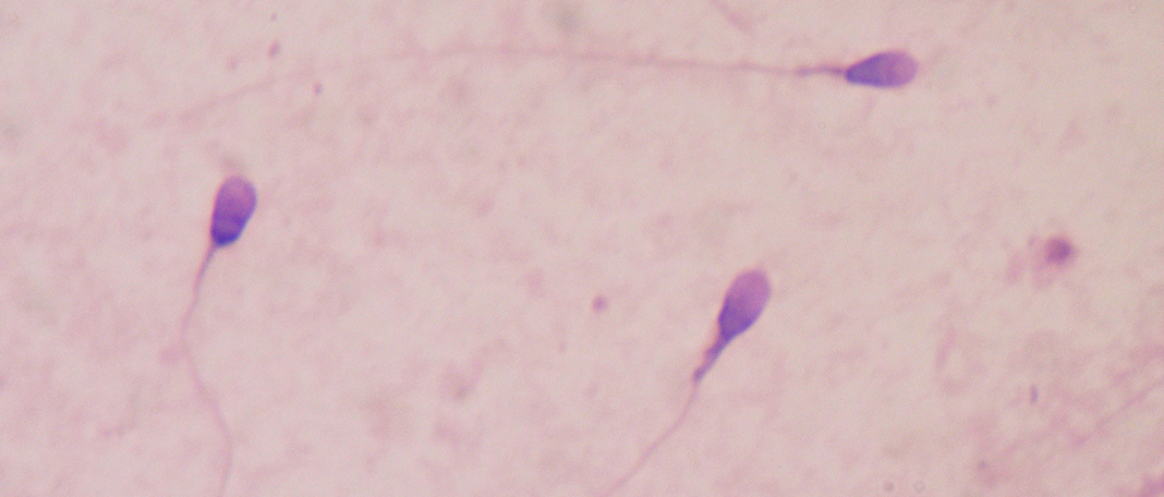 Biomarkers in Human Sperm Are Linked to Their Offspring’s Autism