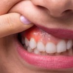 Plain Sailing Ways to Treat Sore Gums
