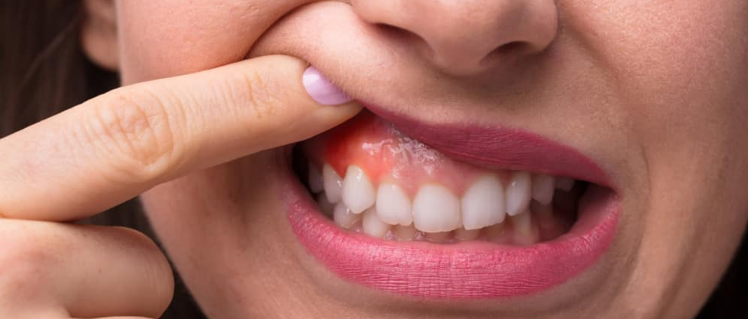 Plain Sailing Ways to Treat Sore Gums