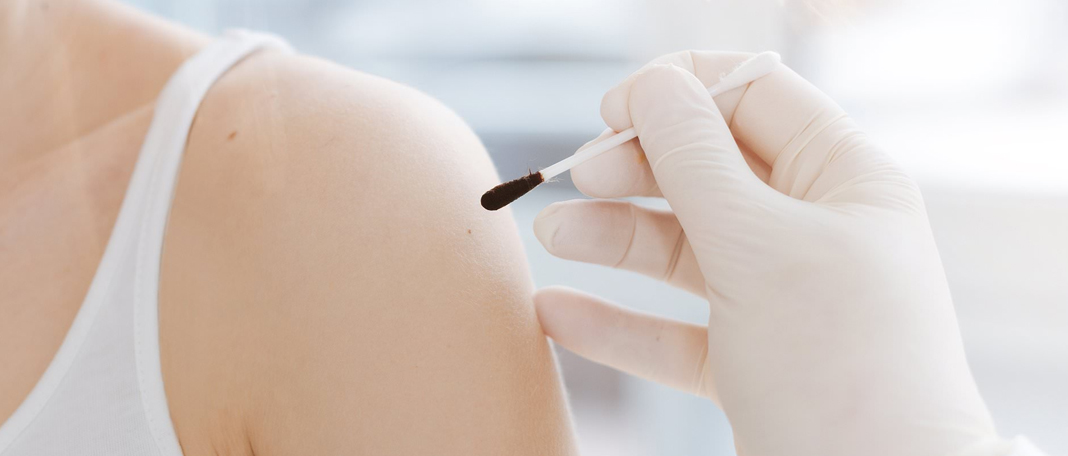 Painless Skin Swabs That Diagnose Parkinson’s