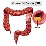 Can Baby Aspirin Cure Colorectal Cancer?