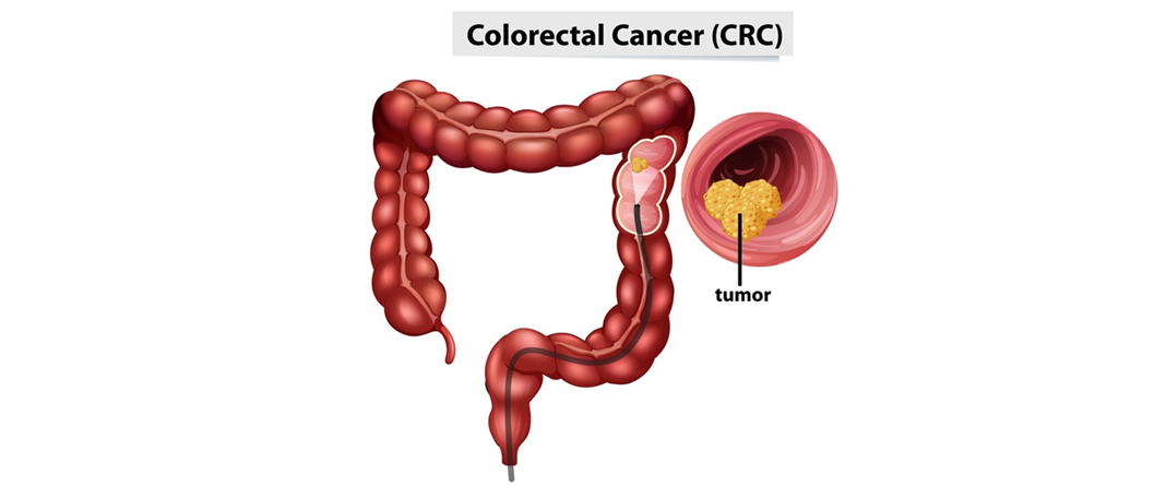 Can Baby Aspirin Cure Colorectal Cancer?