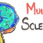 4 Things About Multiple Sclerosis For You