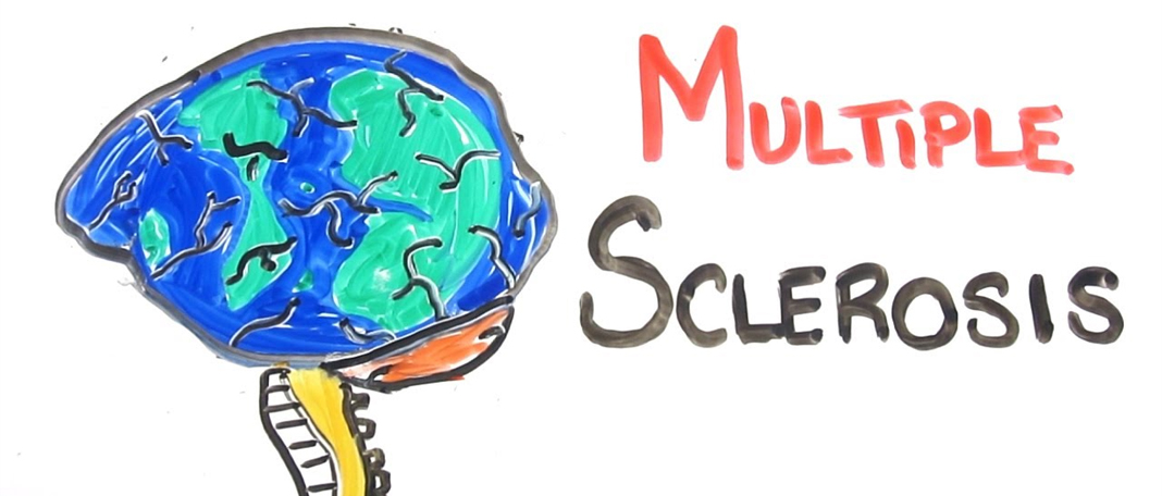 4 Things About Multiple Sclerosis For You
