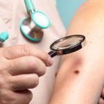 6 Ways to Detect Skin Cancer Early