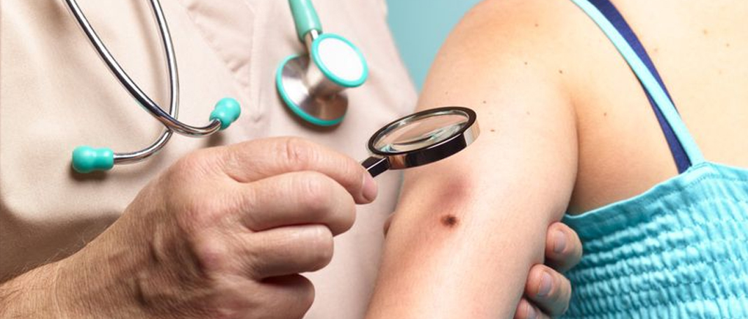 6 Ways to Detect Skin Cancer Early