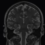 Some Types of Body Fat Decrease the Quantity of Gray Brain Matter