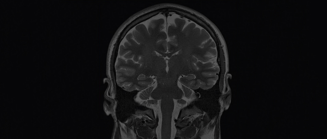 Some Types of Body Fat Decrease the Quantity of Gray Brain Matter