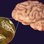 Brain-Eating Amoeba Infection Rises in the U.S.