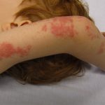 Shingles Disease: Causes, Symptoms, and Treatment
