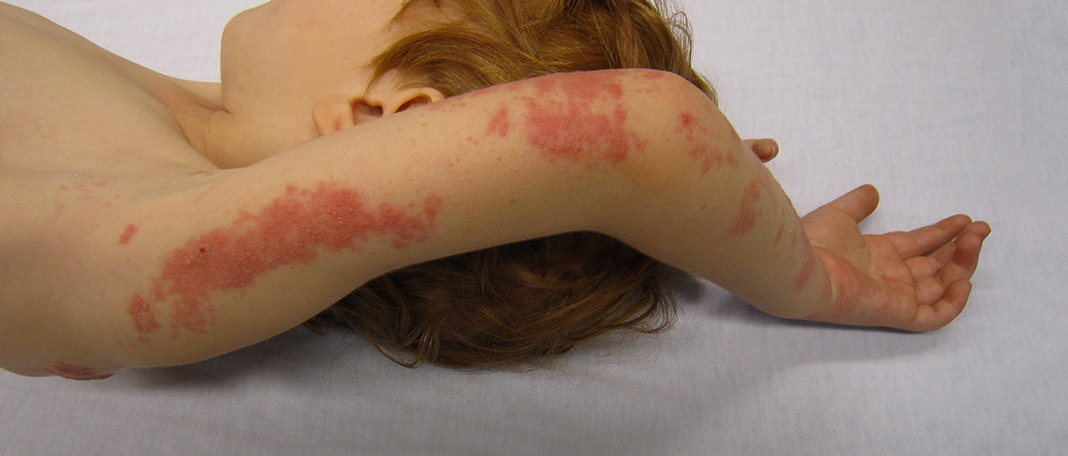Shingles Disease: Causes, Symptoms, and Treatment