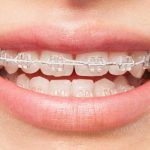 A Complete Guide to Tooth Braces