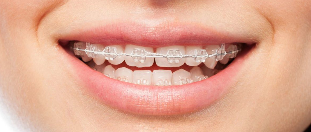 A Complete Guide to Tooth Braces