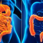 Crohn’s Disease vs Ulcerative Colitis