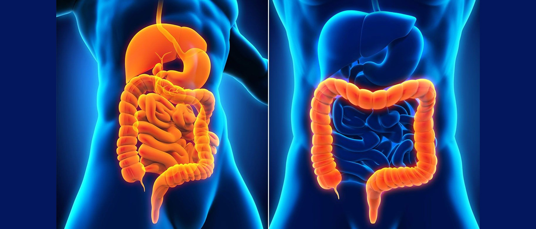Crohn’s Disease vs Ulcerative Colitis