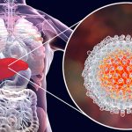 Hepatitis A, B, C, D, E: Causes, Symptoms, & Treatments