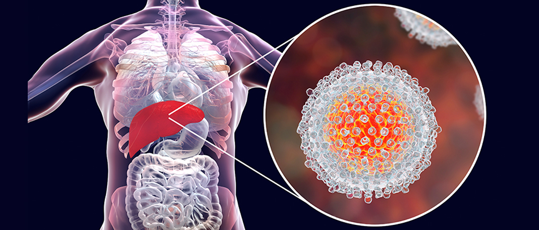 Hepatitis A, B, C, D, E: Causes, Symptoms, & Treatments