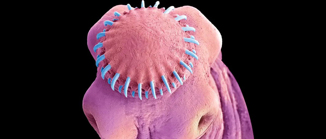 A Man with Tapeworm in Brain Suffered from Mysterious Seizures!