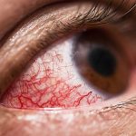 How to Spot Early Signs of Diabetes Eye Problems?