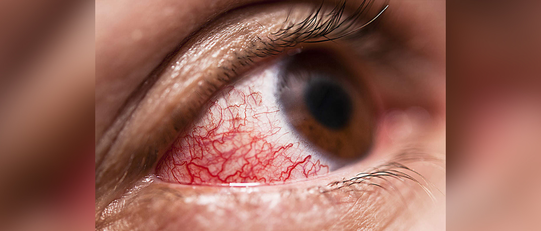 How to Spot Early Signs of Diabetes Eye Problems?