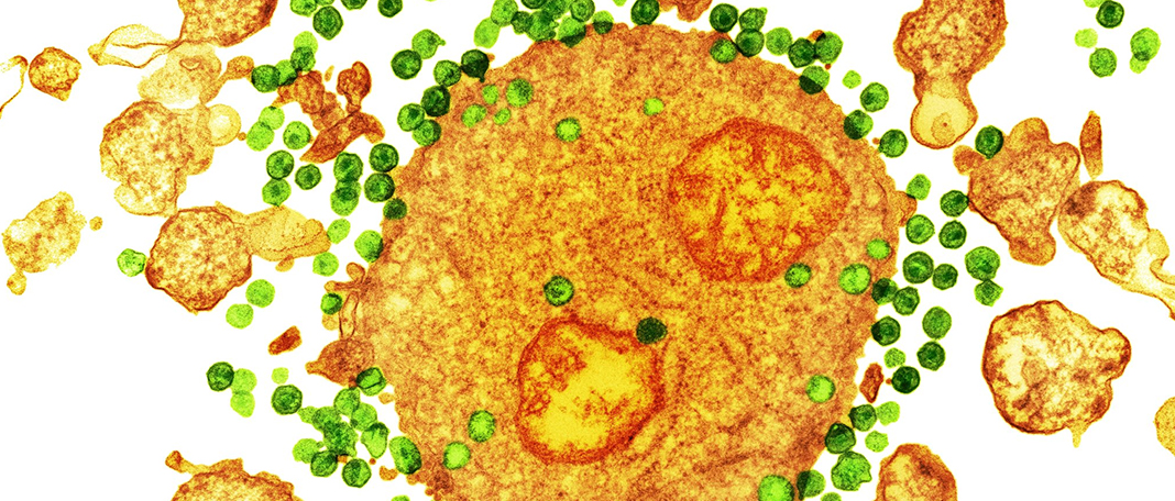 Is There a Natural Cure for HIV and AIDS?