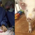 Pig Kidney Transplant to Human for the First Time