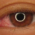 Contact Lens Risks You Shouldn’t Overlook