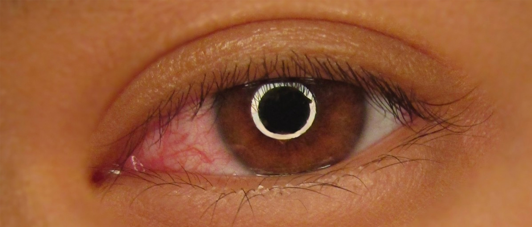 Contact Lens Risks You Shouldn’t Overlook